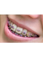 Fixed Braces - Bala Dental Clinic