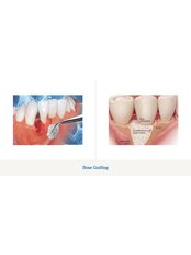 Bone Graft  - Bala Dental Clinic