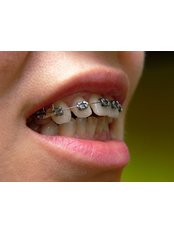 Metal Braces - Bala Dental Clinic