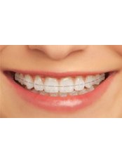 Ceramic Braces - Bala Dental Clinic