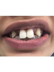 CAD/CAM crowns - Cosmetic Dental Clinic