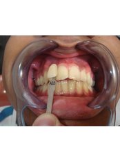Laser Teeth Whitening - Dental Cosmetics and Implant Centre - Bangalore 2