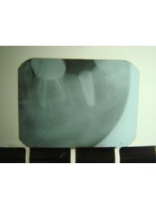 Implant Dentist Consultation - Dental Cosmetics and Implant Centre - Bangalore 2