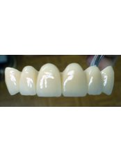 Dental Crowns - Dental Planet
