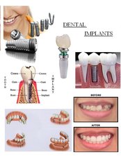 Dental Implants - Dental Planet