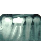 Molar Root Canal - Dental Planet