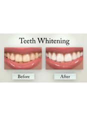 Laser Teeth Whitening - Dental Solutions Bangalore