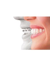 Clear Braces - Dental Solutions Bangalore