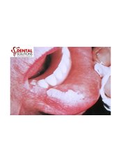 Gum Surgery - Dental Solutions Bangalore