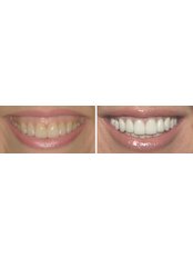 Dental Crown lengthening - Dental Solutions Bangalore