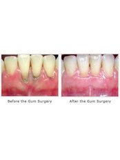 Laser Assisted Flap Surgery - Dental Solutions Bangalore