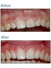 Gum Contouring and Reshaping - Dental Solutions Bangalore