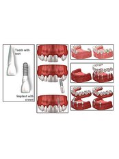 Dental Implants - Dental Solutions Bangalore