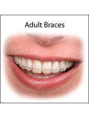 Adult Braces - Dental Solutions Bangalore