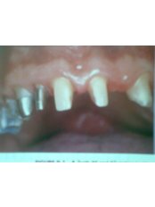 Dental Bridges - Nayan Dental Clinic