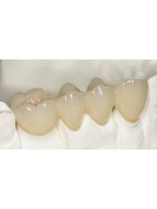 Porcelain Bridge - Nayan Dental Clinic