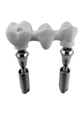 Implant Bridge - Nayan Dental Clinic