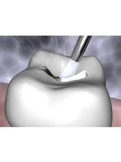 Air Abrasion - Orchards Dental Care