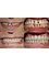 Smiles n More Orthodontic & Invisalign Centre - 318/A,24th cross, 27th main, behind Superfoods,, sector 2, HSR Layout, Bangalore, Karnataka, 560102,  28