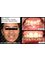 Smiles n More Orthodontic & Invisalign Centre - Braces for DeepBite correction 