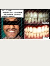 Smiles n More Orthodontic & Invisalign Centre - Clear Aligner(Invisalign)case 2
