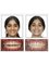 SmilesOn Dental Clinics Immediate loading implants - 1st Floor, Nanjunda Reddy Complex, opp. Cosmos Mall , Brookfields,, Bangalore, Karnataka, 560066,  5