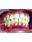 YourDentist dental clinic - dental scaling before 