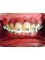 YourDentist dental clinic - dental braces after 