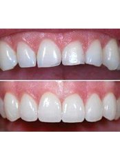 Dental Crowns - Dr. D'Mello's Smile Dental Clinic