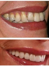 Veneers - Dr. D'Mello's Smile Dental Clinic
