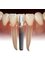 Dentique Calicut - dental implants 
