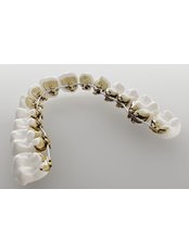 Incognito™ Braces - Dentique Calicut