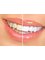 Dentique Calicut - teeth whitening 