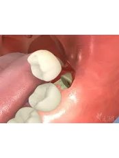 Extractions - Dentique Calicut