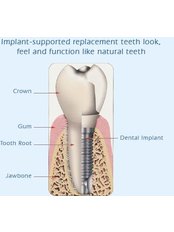 Implant Dentist Consultation - MIDAC Dental Centre
