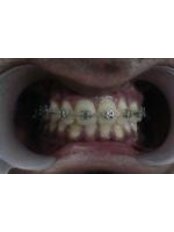 Orthodontist Consultation - 32 Smilez Dental Clinic & Implant Center