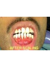 Gingival Flap Surgery - 32 Smilez Dental Clinic & Implant Center