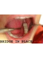 3-Unit Bridge - 32 Smilez Dental Clinic & Implant Center