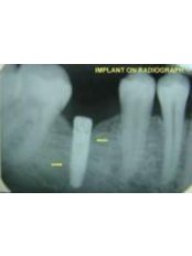 Implant Dentist Consultation - 32 Smilez Dental Clinic & Implant Center