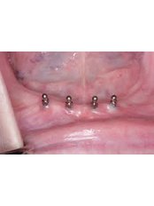 Mini Implants - Avance Dental Care