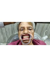Dentures - Aarthi Priyas Tooth Care Clinic