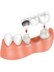 Dental Bridges - Adarsh dental Clinic