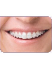 Clear Braces - Adarsh dental Clinic
