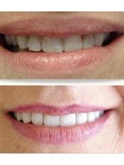 Cosmetic Dentist Consultation - Chennai Dental Clinic