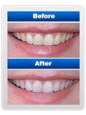 Teeth Whitening - Chennai Dental Clinic