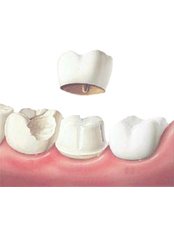 Dental Crowns - Chennai Dental Clinic