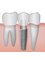 Chennai Dental Clinic - dental Implants 