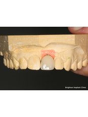 Temporary Crown - Dhanwanth Dental Care