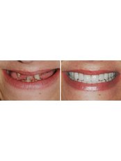 All-on-4 Dental Implants per jaw - Gold Dental Hospital