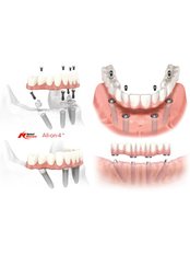 All-on-4 Dental Implants per jaw - Gold Dental Hospital